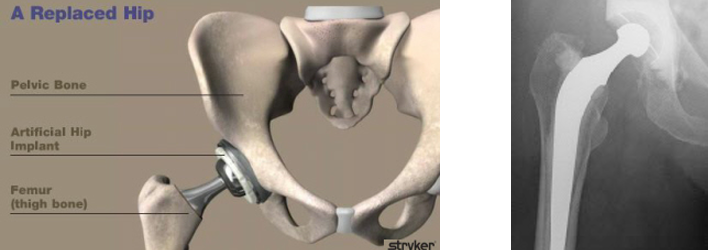 Traditional Charnley hip replacement