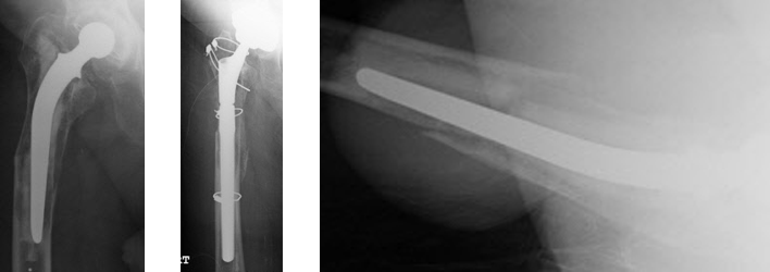 AP hip x-ray showing loose hip replacement and lateral x-ray showing the peri-prosthetic fracture